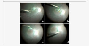 Typical Video Images Of The Surgical Process - Tissue