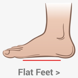 When Your Longitudinal Arch Pronates It Functions Like - Flat Feet