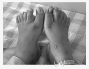 Post-axial Polydactyly In Both Feet - Barefoot