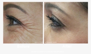 Botox Eye Wrinkles - Botox Before And After Under Eye Wrinkles