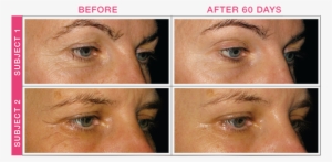 Bottom Line, Subjects Experienced Smoother Skin With - Biosil Effect Before After