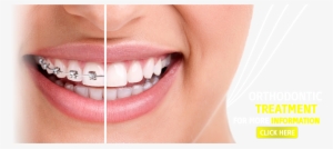 Sevgi Dental Clinic, Dental, Dental Clinic, Dentist, - Braces On Vs Off