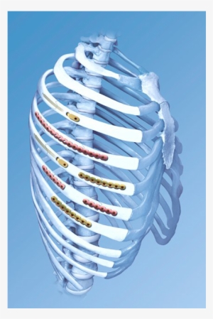 An Image Show Fracture Ribs Treated With Titanium Plates - Rib Fracture Plate
