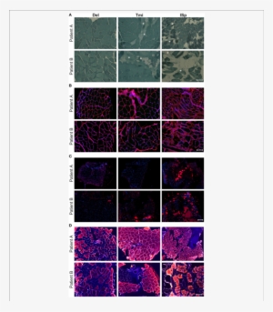 Histological Markers Of Muscle Degeneration In Torn - Muscle