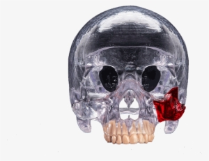 3d Printed Head Skull Transparent Surgical Guide - 3d Printing