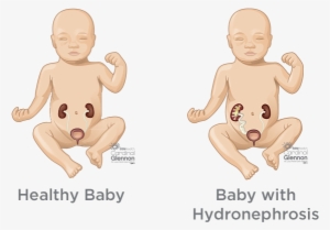 If Your Baby Has Restricted Urine Flow Or Urine Reflux, - Hydronephrosis In Fetus