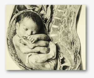 Detail, Near Full Term Fetus Placed With Anatomical - Anatomy