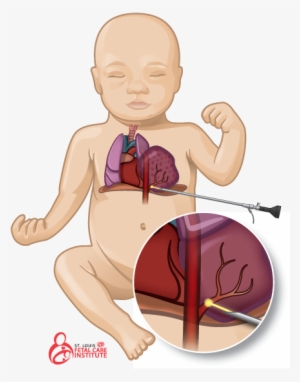 Graphic Of Baby With Bronchopulmonary Sequestration - Bronchopulmonary Sequestration