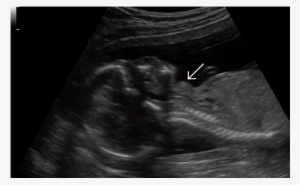 Fetal Goiter - Fetal Goiter Ultrasound
