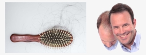 Hair Loss Treatments & Hair Transplant - Dermmatch Hair Loss Concealer Medium Brown