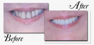 Our Patient Had Existing Old White Fillings In Her - White Fillings Front Teeth