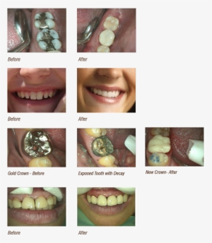 Before And After Cosmetic Dentistry Image - Castle Valley Dental