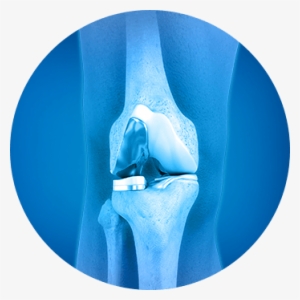 About Partial Knee Joint Replacement - Joint K Nee Png