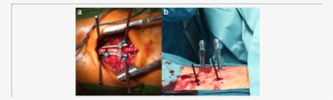 Open Approach For Pedicle Screw Placement And Minimal - Common Fig