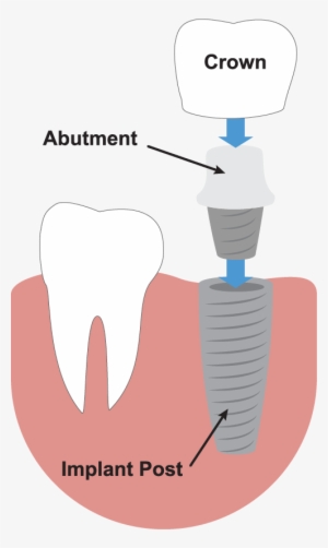 dental implants illustration - dental implant