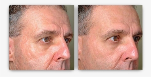 *results May Vary - Profractional Laser Before And After
