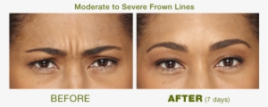 Botox Is An Advanced Skin Treatment That Is Extremely - Botox Areas Before And After