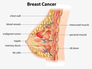 Breast Cancer Pic Clipart - Breast Cancer