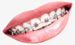 teeth with braces png transparent image - teeth with braces png