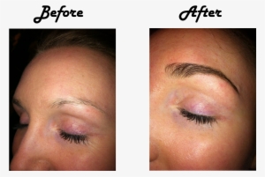 Eyebrow - Prp Treatment For Eyebrows