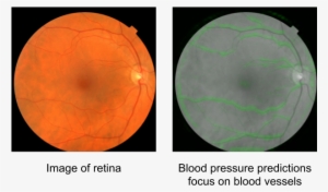 Image Of The Back Of The Eye Showing The Macula , Optic - Retinal Signs Heart Disease