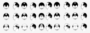 Baldheader1600 - Hair Loss Pattern