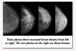 The Problem With High Density Breasts Is That Tumors - Dense Breast Mammogram