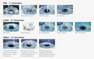 Laser Vision Correction Techniques - Prk Vs Lasik Vs Smile