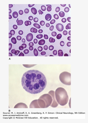 Image Not Available - Pernicious Anemia Cytology
