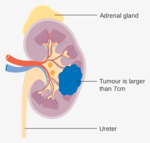 Open - Kidney Cancer Diagram