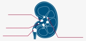 Types Of Kidney Stones - Graphic Design