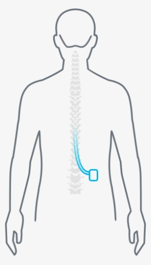Human Diagram Nevro - Spinal Cord