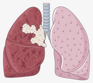 Clipart Library Clipart Lungs - Milo Yiannopoulos Twitter Roasts