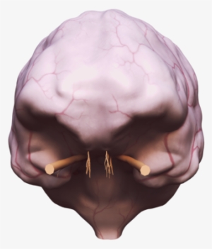 9303727, Brain With Dura Mater - Skull