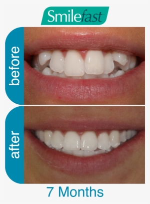 Aqd Smilefast After 7-months - Smilefast Before And After