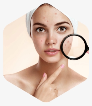 Acne Png - Praventac Natural Reduce Acne Pimple Blemishes Scar