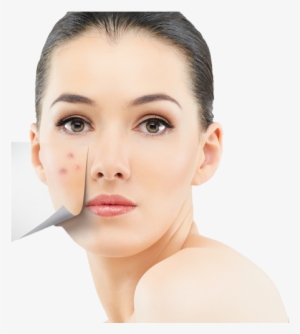 Acne Treatment