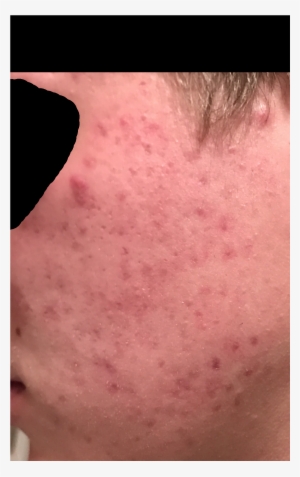 Acne Help - Face