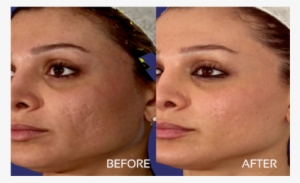 acne scars - laser skin resurfacing before