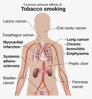File Adverse Effects Of Smoking Png Wikimedia - Anafilakticki Sok