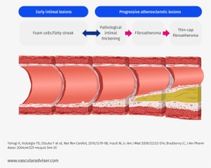 Atherosclerotic Lesion Development - Lesion