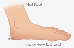 Flat Foot 1 - Flat Foot Disease