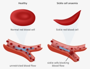 Normal Red Blood Cell And Sickle Cell