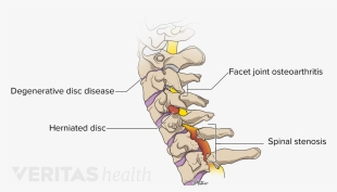 conditions that may occur in the cervical spine - cervical vertebrae