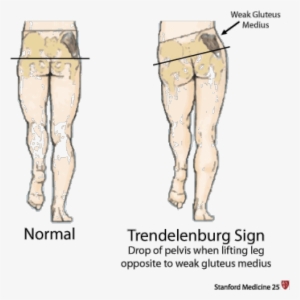 Hip Girdle Muscles Are Responsible For Keeping The - Trendelenburg Sign