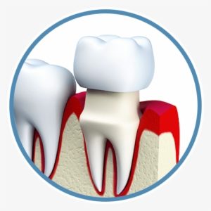 Dental Crowns - Tooth Porcelain Figure Png