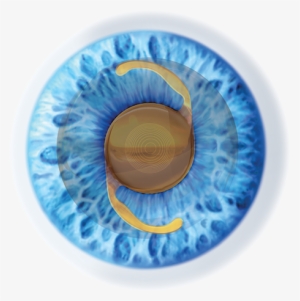 Select The Most Suitable Lens For The Patient From - Cataratta Operazione