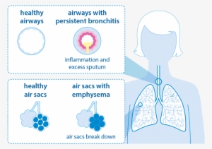 Copd Bronchitis Emphysema Graphic - Finding The Missing Millions Copd