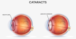 Anatomy Of The Eye With Cataracts - Diagram Of Cataract