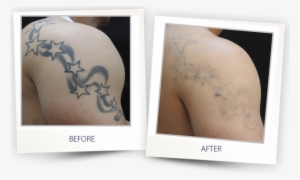 Pre Treatment - Clearlift Tattoo Removal